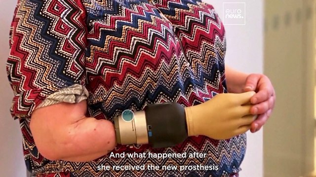 ‘Groundbreaking’ bionic arm that fuses with user’s skeleton and nerves could advance amputee care