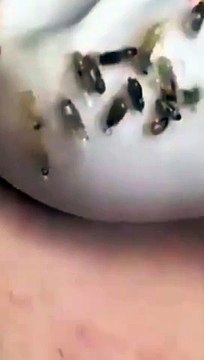 Cheeks blackhead removal Satisfying blackhead ASMR #blackheads #asmr #satisfying