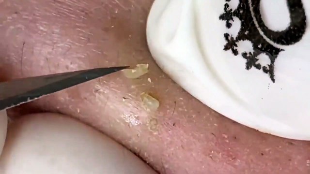 BLACKHEADS REMOVAL, Blackhead Buster Say Goodbye to Pesky Blackheads!
