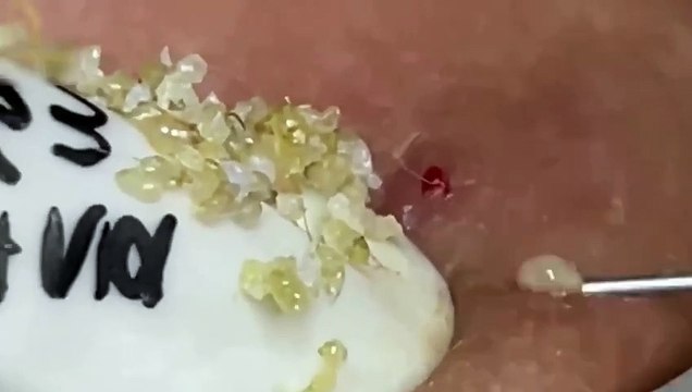 Blackheads- Pimples- Acne- Steatocystoma #4