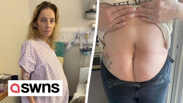 I felt like Frankenstein's Monster after a two-stone tumour growing in my womb had to be removed
