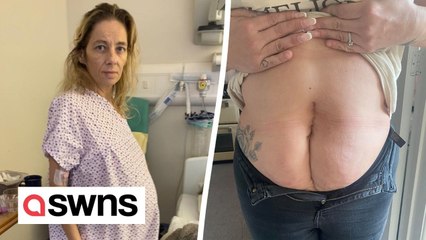 "I felt like Frankenstein's Monster after a two-stone tumour growing in my womb had to be removed"