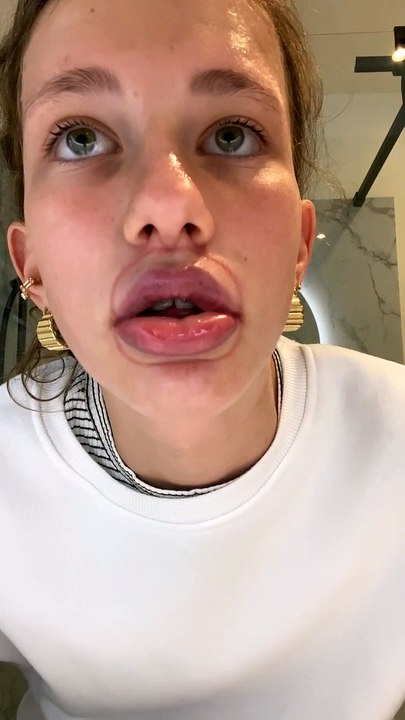 Accidentally Over-Plumped Lips