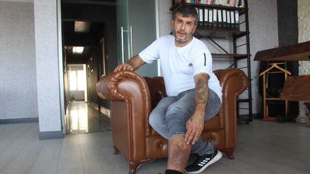 Bacağında unutulan bez parçasıyla 16 yıl yaşadı