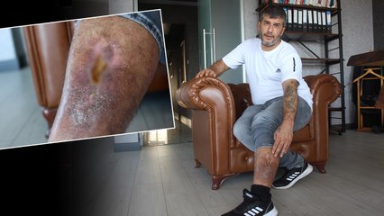 Bacağında unutulan bez parçasıyla 16 yıl yaşadı