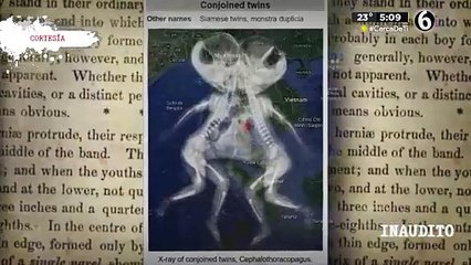 Los siameses que fueron vendidos al circo y descubrieron el negocio millonario