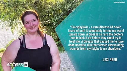 Fitness Influencer Lexi Reed Embraces Scars From Rare Disease Amid 'Terrifying'