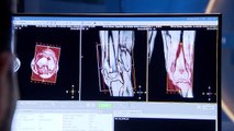 Las fracturas por fragilidad son la cuarta enfermedad crónica de mayor impacto en España