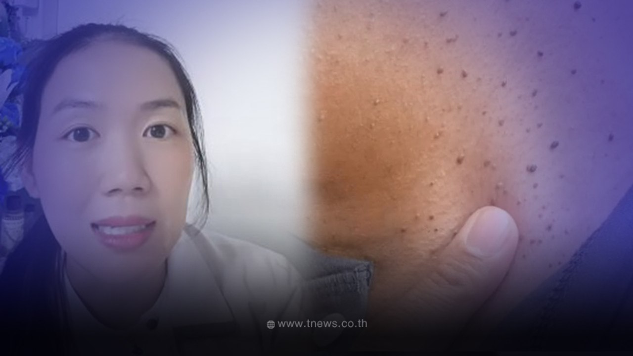หมออิง เผย ใครมีตุ่มหรือติ่งเนื้อที่คอ เป็นสัญญ...