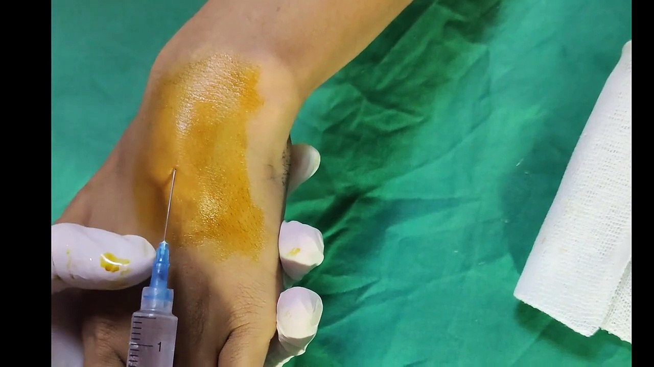 Ganglion Cyst Aspiration and Steroid Injection Ganglion Cyst Removal
