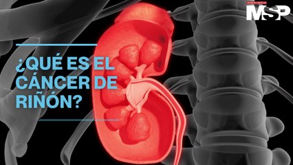 Así funciona el cáncer de riñón - #ExclusivoMSP