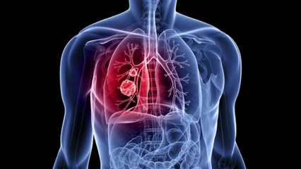 Cáncer de Pulmón, el enemigo subestimado