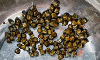 Phẫu thuật lấy 113 viên sỏi thận từ bụng bệnh nhân nữ