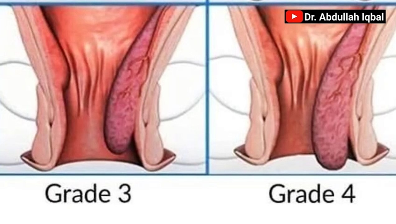 Does Piles Come Back After Surgery_ Bawaseer Ka Ilaj _ Piles Operation