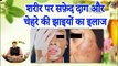 शरीर पर सफ़ेद दाग और चेहरे की झाइयों का अचूक इलाज | Treat Leucoderma & Melasma With Home Remedies