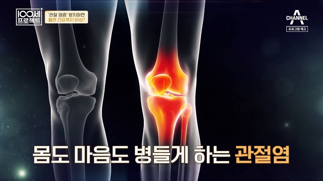 [예고] 극심한 관절 통증 원인은 염증! 몸도 마음도 병들게 하는 관절염을 주의하라