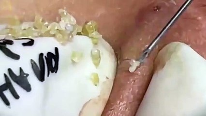 Blackheads- Pimples- Acne- Steatocystoma 4