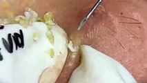 Cyst- Blackheads- Pimples- Acne- Steatocystoma 6
