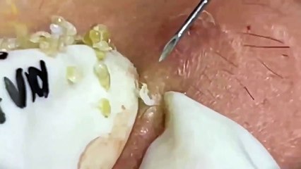 Cyst- Blackheads- Pimples- Acne- Steatocystoma 6