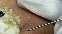 Cyst- Blackheads- Pimples- Acne- Steatocystoma 7