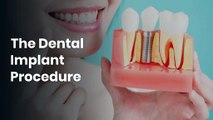 Dental Implants A Permanent Solution for Missing Teeth