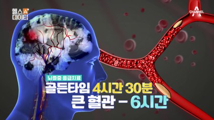 일교차가 크면 뇌졸중 위험이 커진다?! 뇌졸중의 전조증상은?