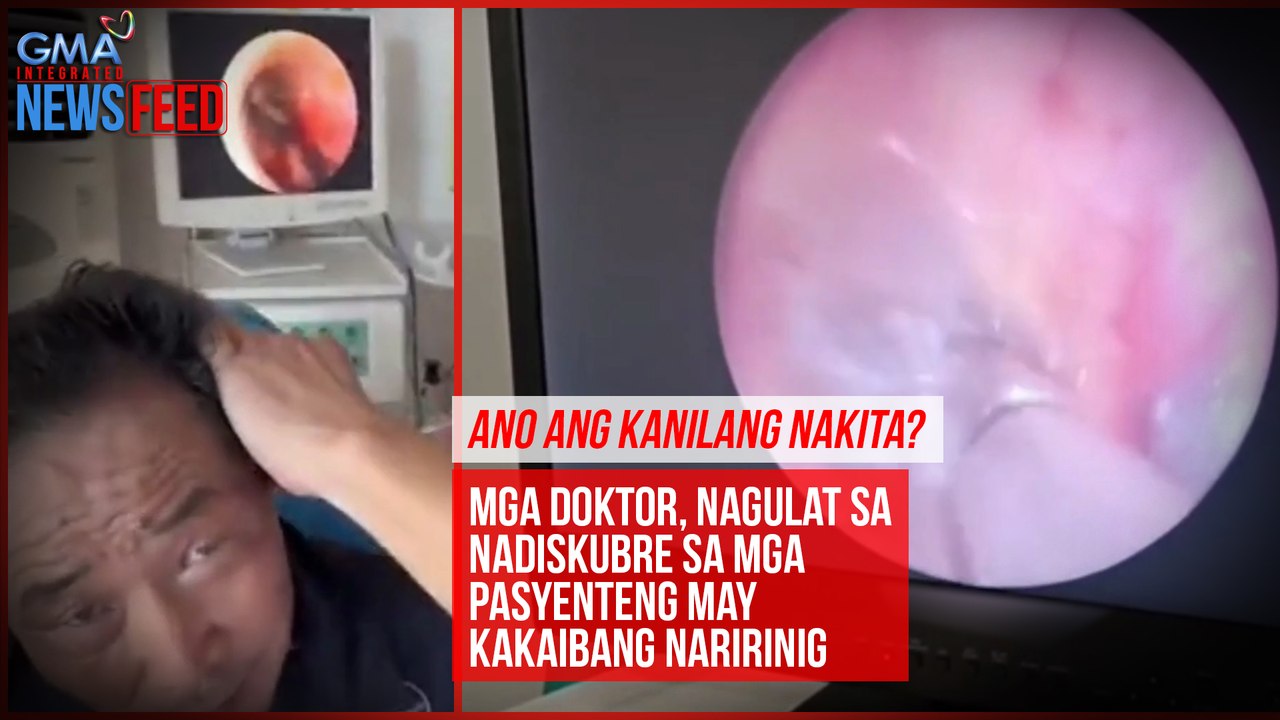 Ano ang kanilang nakita? Mga doktor, nagulat sa nadiskubre sa mga pasyenteng may kakaibang naririnig | GMA Integrated Newsfeed