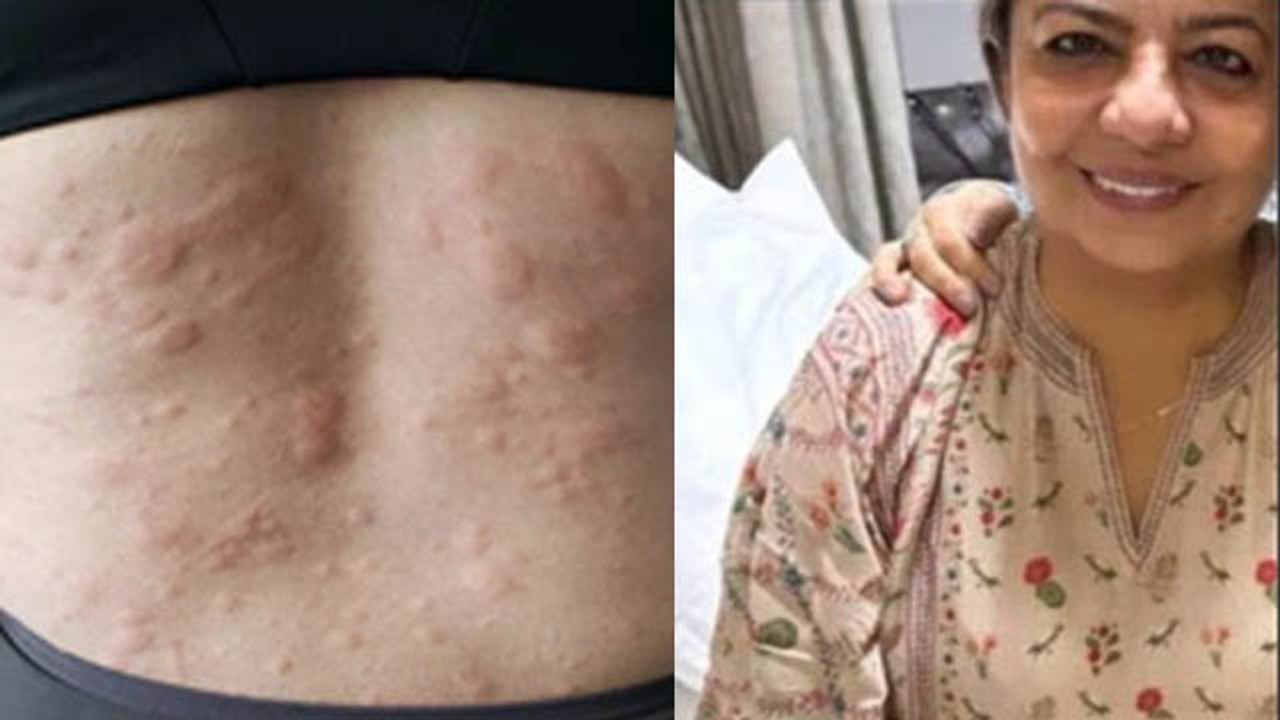 Piyanka Chopra Mother Madhu Chopra को हुआ Anaphylaxis | Skin Allergy Symptoms Treatment In Hindi