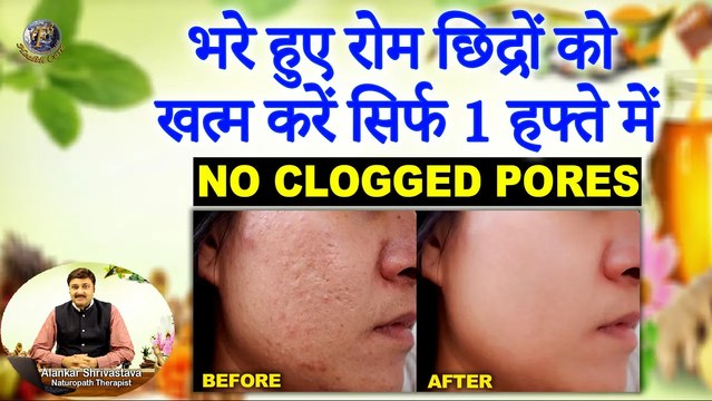 भरे हुए रोम छिद्रों को जड़ से खत्म करें सिर्फ 1 हफ्ते में | Get Rid Of Clogged Pores Permanently