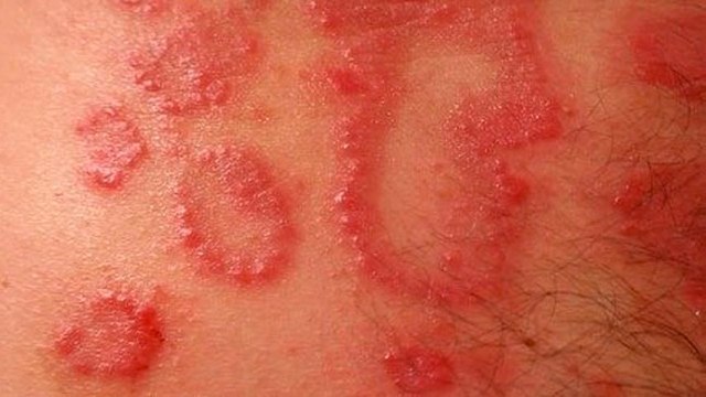 Factores de riesgo ante la dermatitis de contacto