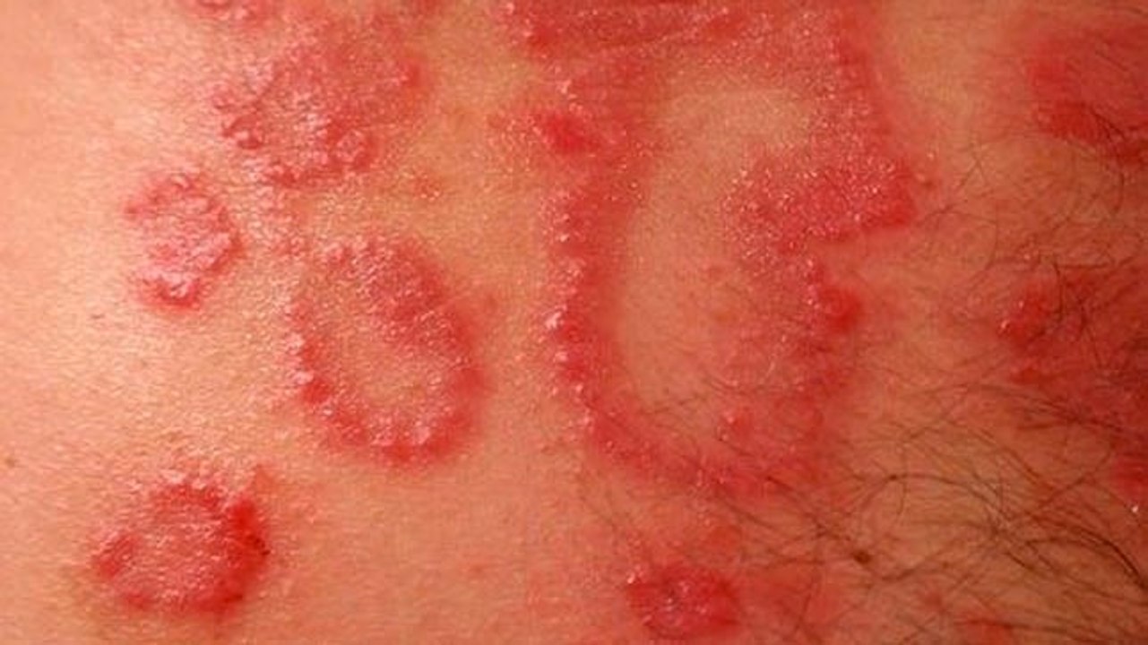 Factores de riesgo ante la dermatitis de contacto