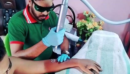 ট্যাটু রিমুভ করুন স্থায়ীভাবে লেজার করে | Tattoo Remobal | Laser Treatment