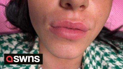 "I got addicted to lip fillers aged 16 - the procedure should be moretightly regulated"