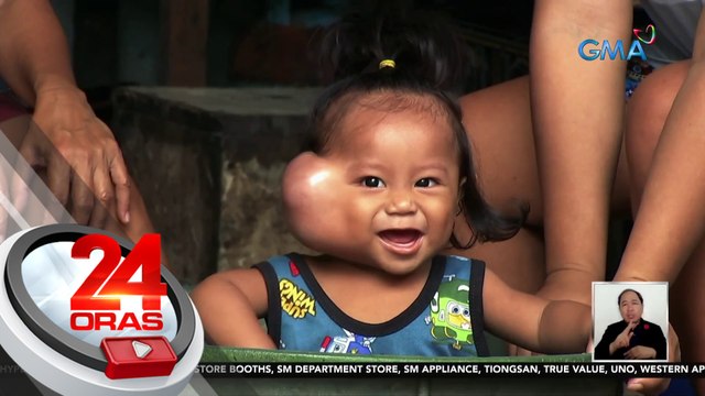 Kondisyon ng batang may malaking bukol sa pisngi, idinulog sa GMA Kapuso Foundation | 24 Oras