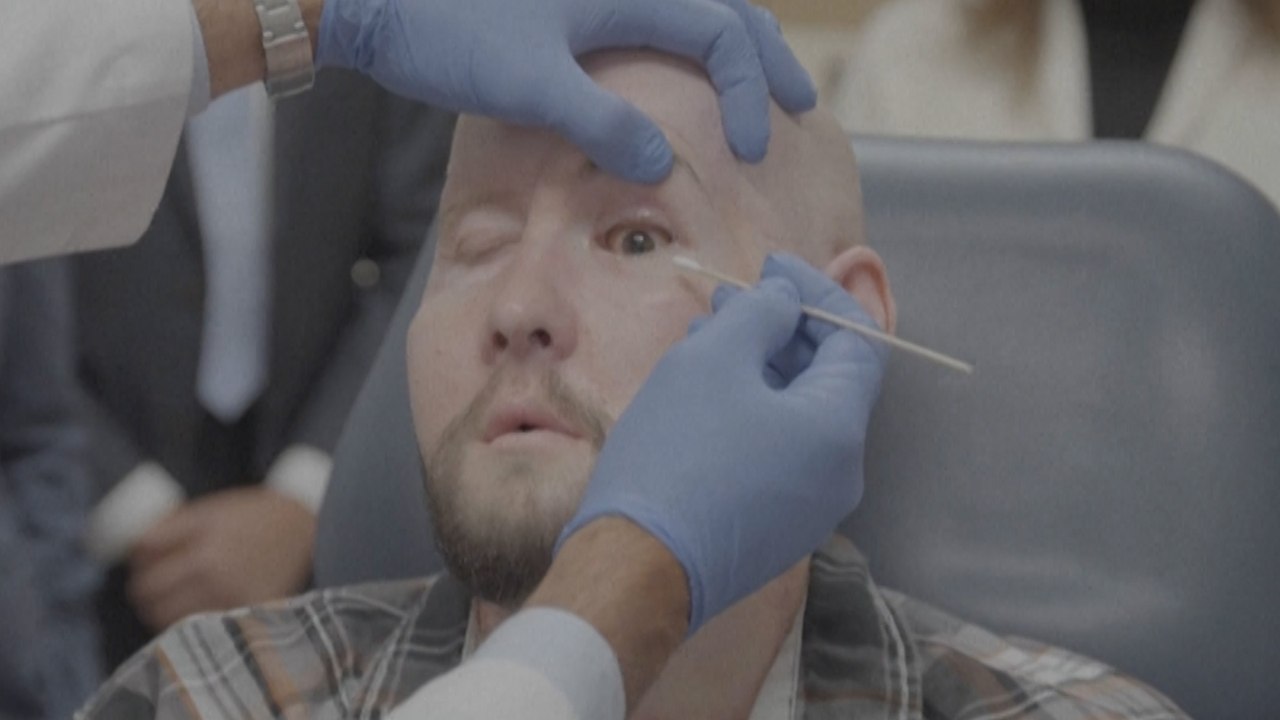 États-Unis : cet Américain se fait greffer un œil complet, une première mondiale