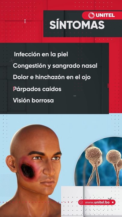 Detectaron la extraña y grave enfermedad de hongo negro en Santa Cruz, Pero ¿Qué es?, ¿Cuáles son sus síntomas?, ¿es contagioso?