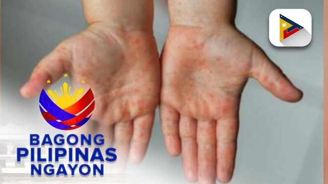 Panayam kay infectious diseases expert Dr. Rontgene Solante