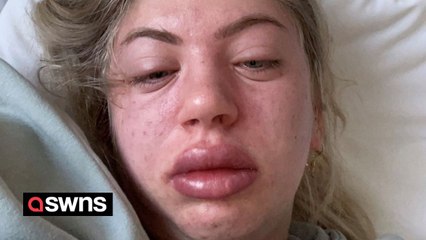 Lash tech force to give up job after it triggered allergy to ‘everything’