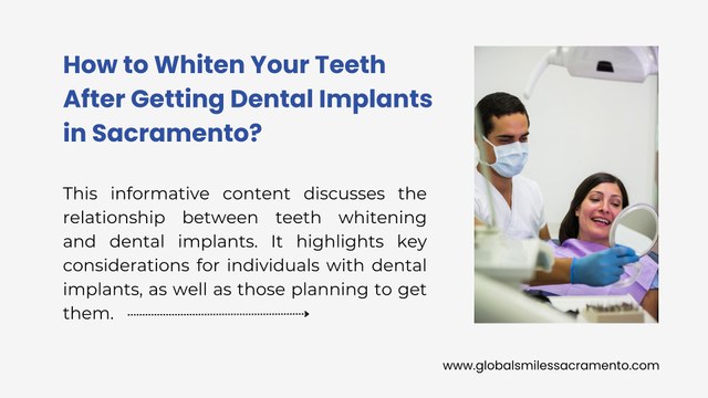 Can I Whiten My Teeth After Getting Dental Implants?