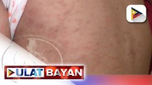 DOH: Bilang ng mga kaso ng tigdas sa bansa, tumaas ng 300% ngayong taon