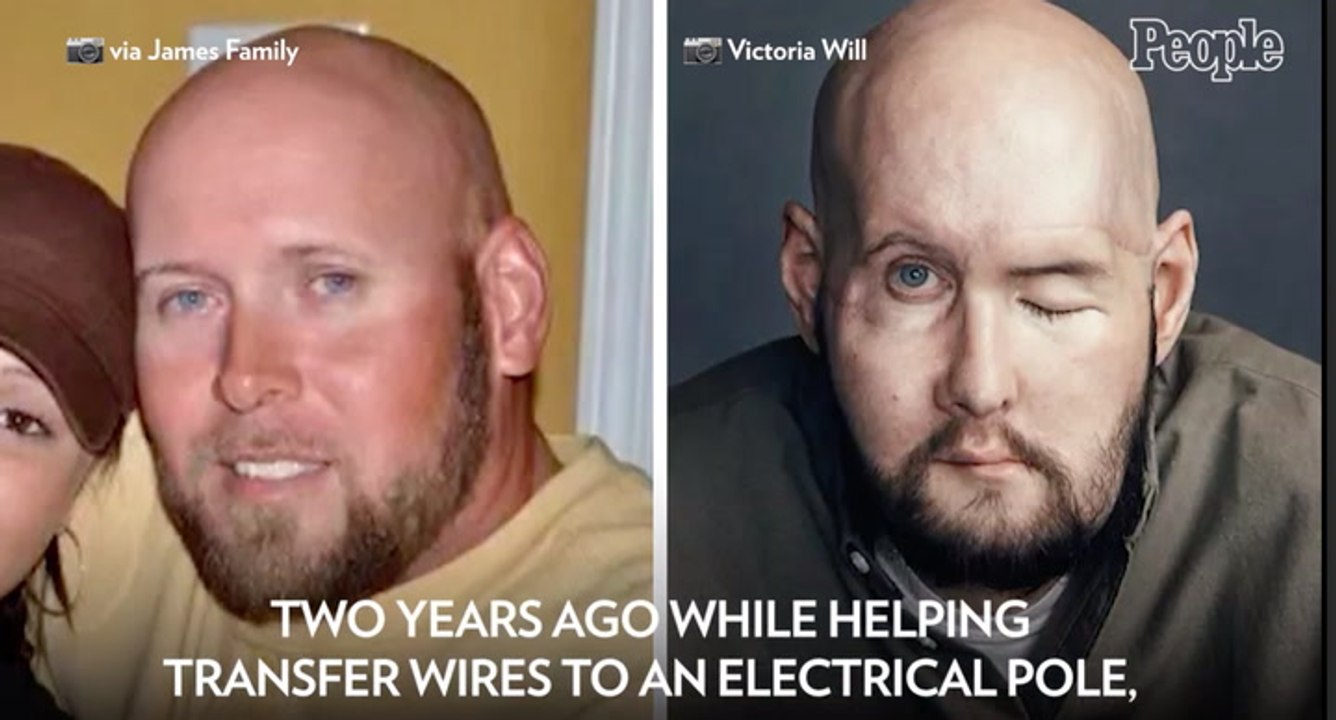 Aaron James Lost Half His Face from Electrocution. He Just Received the First-Ever Eye and Face Transplant (Exclusive)