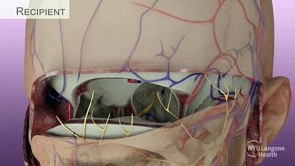 Cirurgiões dos EUA realizam primeiro transplante completo de olho do mundo