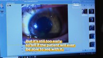 Surgeons successfully perform the world's first transplant of a whole human eye