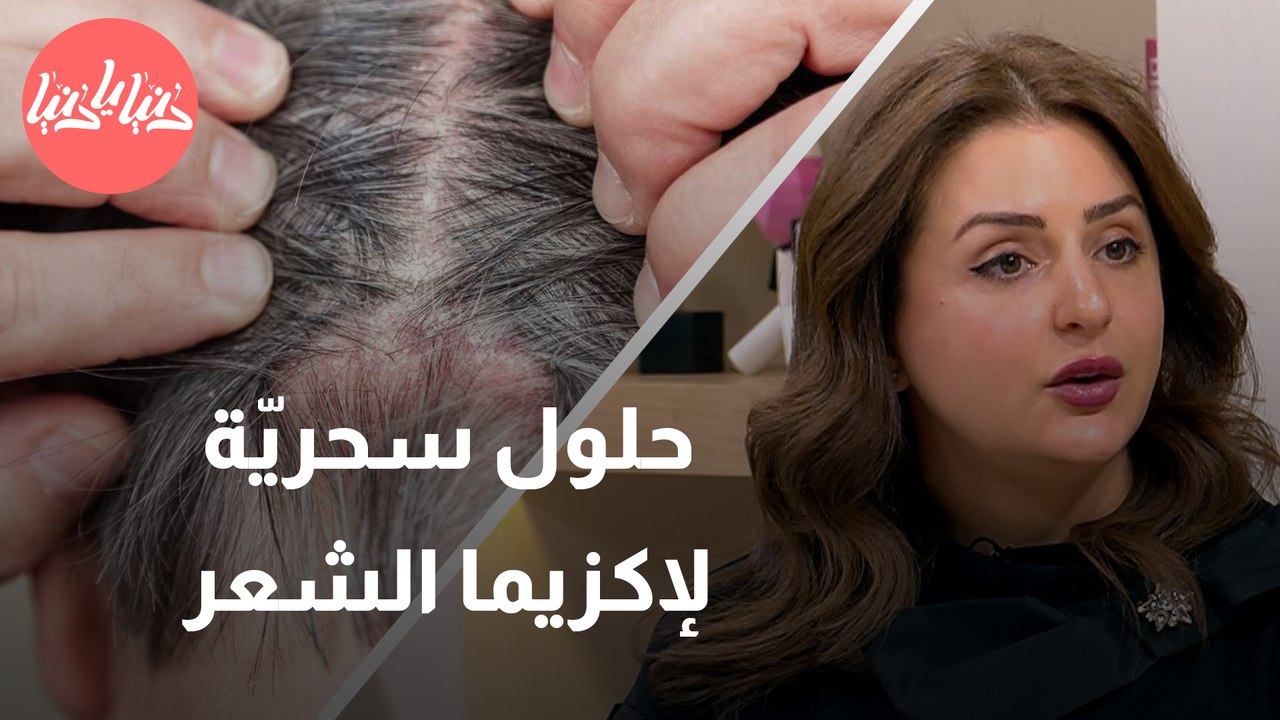 كيف تتغلّب على إكزيما الشعر؟ طبيبة جلديّة تُجيب