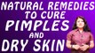 मुँहासो और रूखी त्वचा के लिए प्राकृतिक उपचार | Natural Remedies To Cure Pimples & Dry Skin