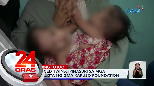 Conjoined twins, ipinasuri sa mga espesyalista ng GMA Kapuso Foundation | 24 Oras