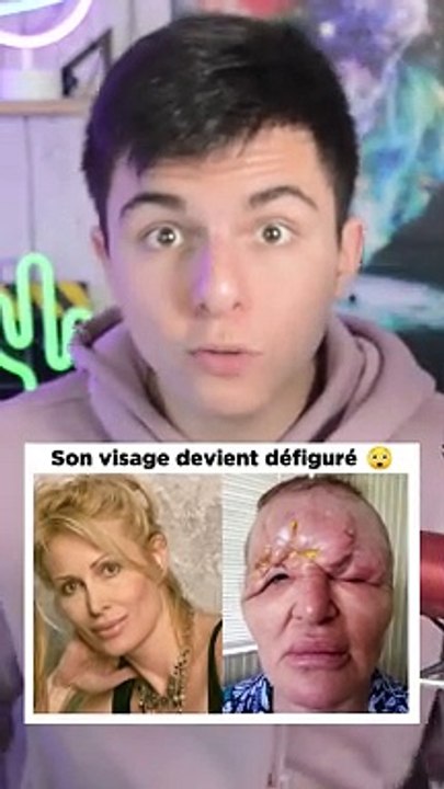 Son visage devient défiguré après de la chirurgie esthétique 