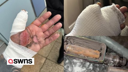 Скачать видео: Man suffers horror injuries after e-cigarette exploded in his hand