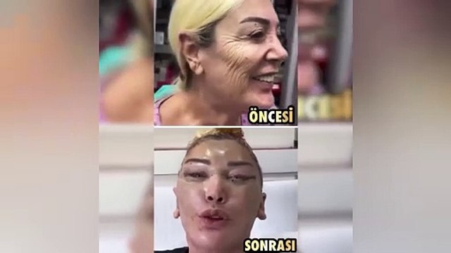 Seda Sayan'ın ablası estetik operasyonu geçirdi! Son halini görenler gözlerine inanamadı