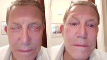 Man unable to close eyes for four years due to surgery complications